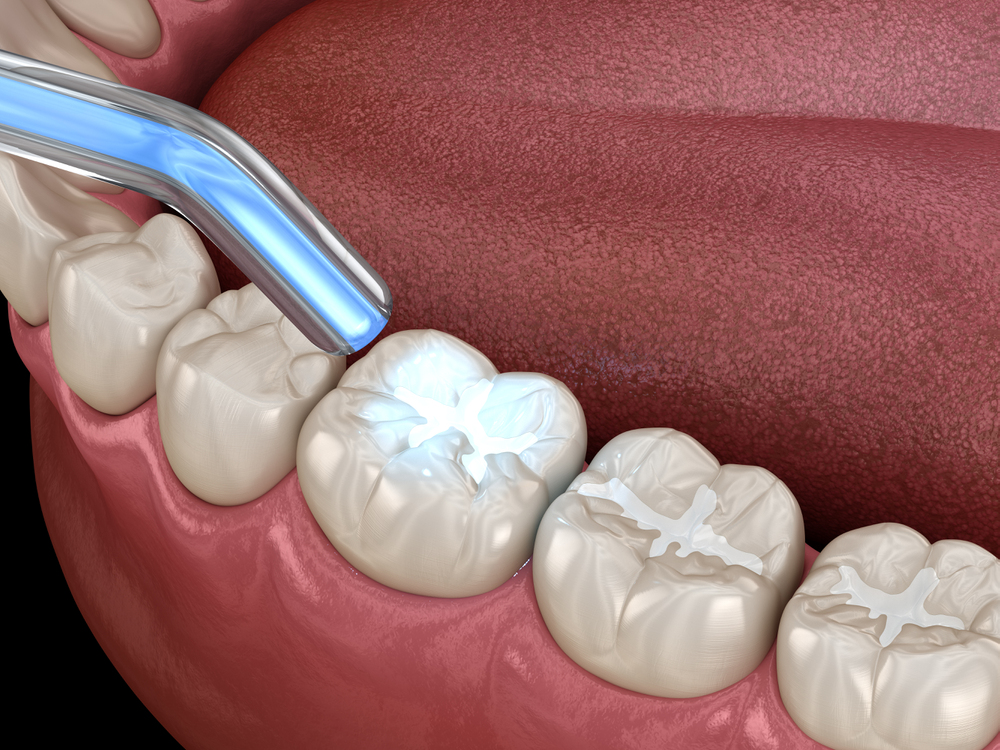 What Should You Do If Your Dental Fillings Falls Out?